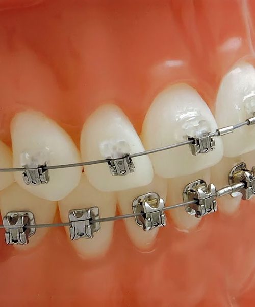 bezligaturnye-braces-qoj02l27w4qq1lrjwdapojtdsrzqnxpubtjr017m28 Безлигатурные брекеты